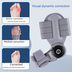 Upgraded adjustable bunion corrector with straps and padding for realignment and comfort.